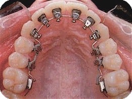 lingual braces Melbourne